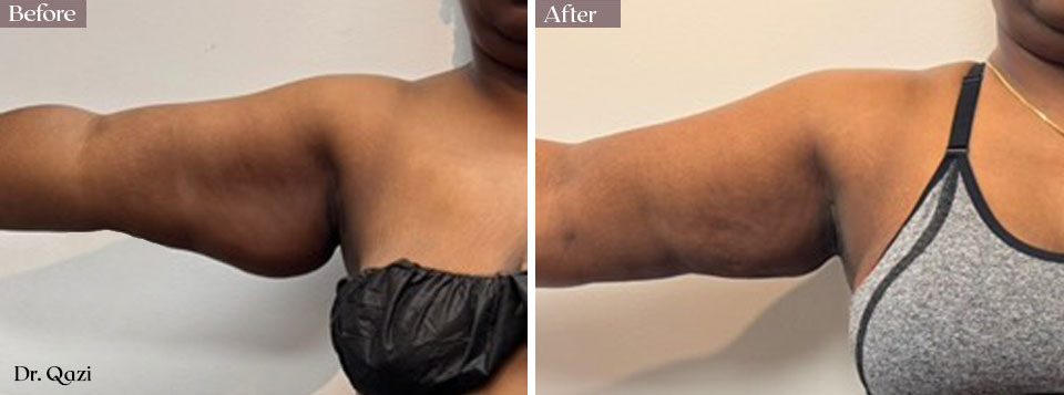 smartlipo arms before after